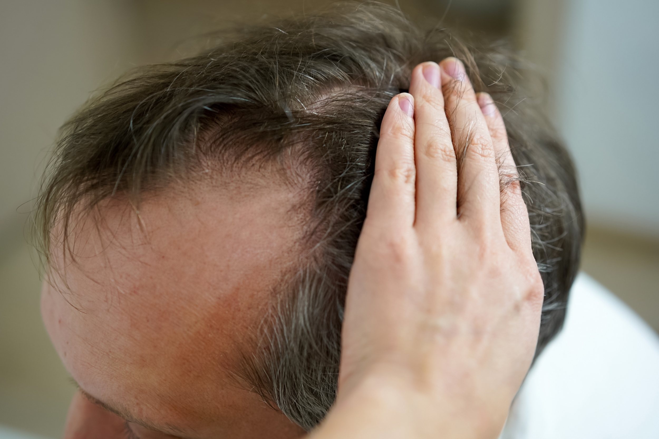 Hair Loss Treatment